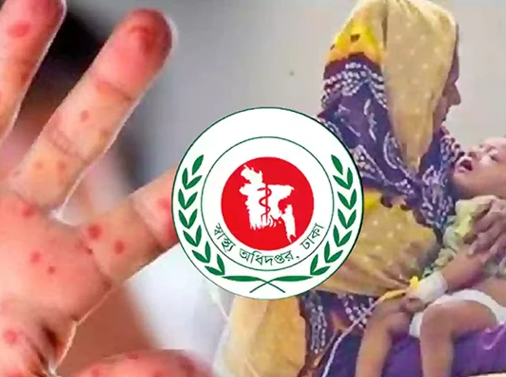 হাম উপসর্গে আরও ৫ জনের মৃত্যু