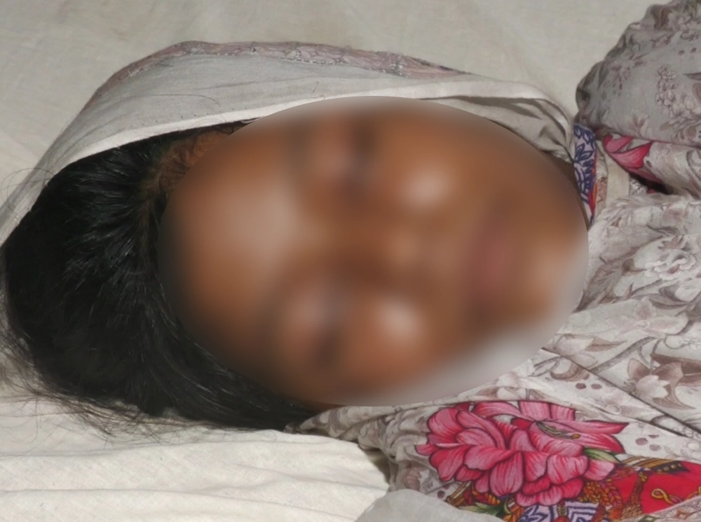 যৌতুক না পেয়ে গৃহবধূর শরীরে এসিড লাগিয়ে নির্যাতনের অভিযোগ