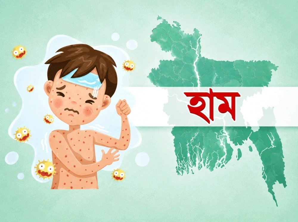সিলেটে হাম উপসর্গে আরও ২ শিশুর মৃত্যু